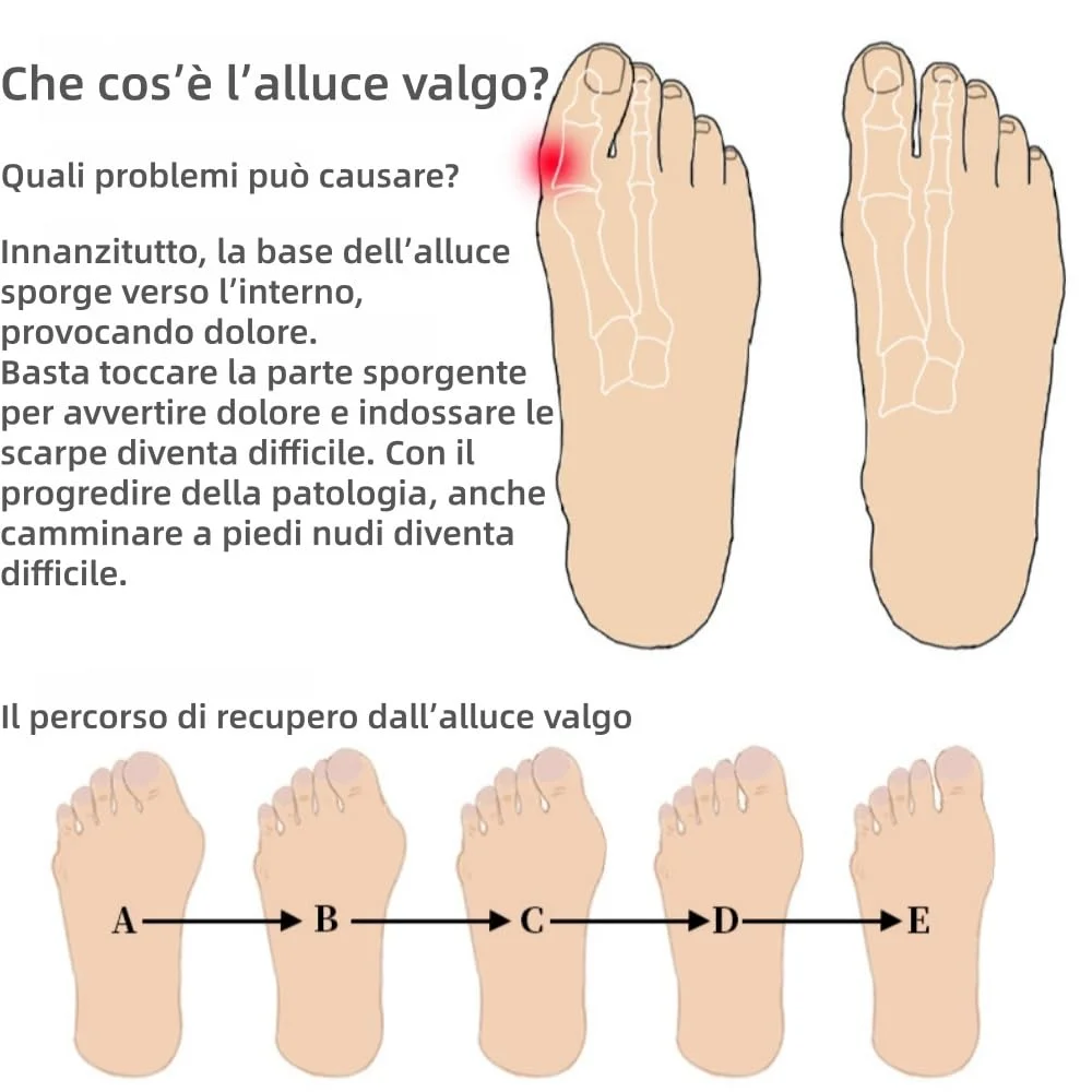 MEIION distanfix alluce valgo,per Uomini e Donne, Morbido Supporto,materiale in silicone,Comfort,Indicato per l'alluce valgo