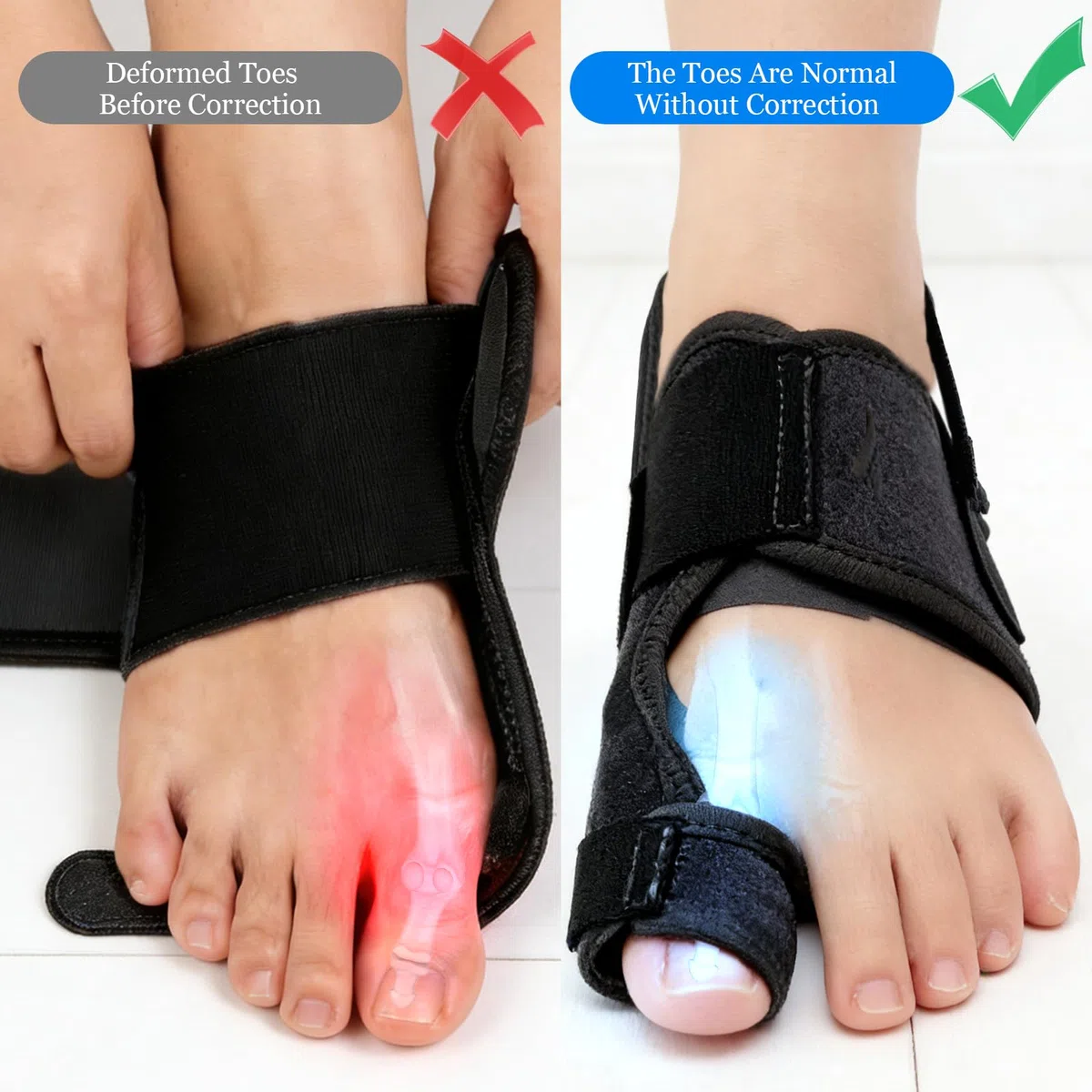 Alluce Valgo Correttore, con 2 Barre Angolari,Tutore Alluce Valgo con Cuscinetto in Silicone, Giorno e Notte, Regolabile Correttore Dei Piedi per Donna e Uomo (1 Paio)