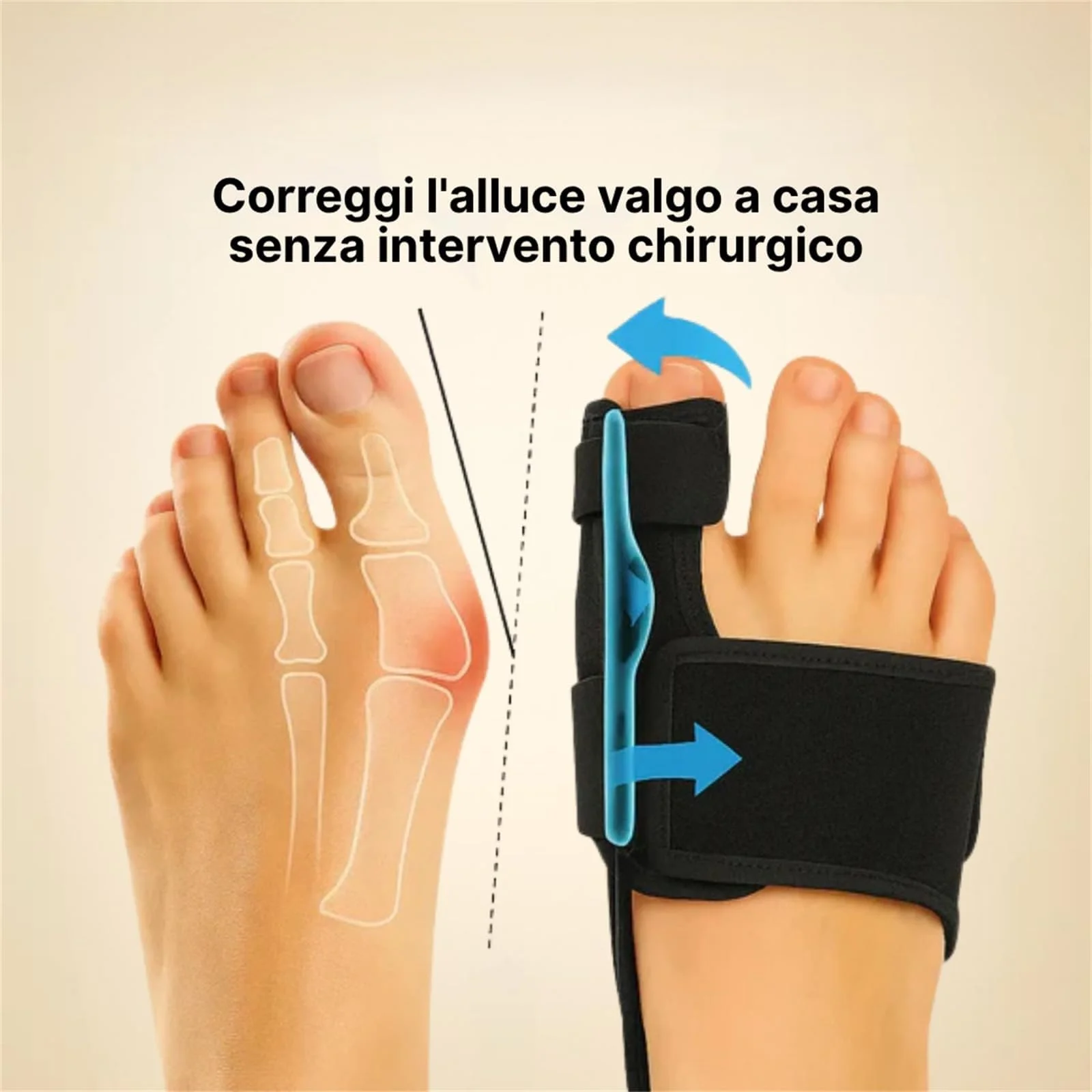 Generico Ortolex Valgux Tutore, 1 paio di stecche correttive per dita dei piedi, Correttore dell’alluce valgo (Hallux Valgus) separatori regolabili unisex, protezioni per alluce e dita